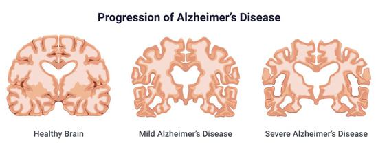 阿尔茨海默病患者大脑与健康人类大脑组织的比较