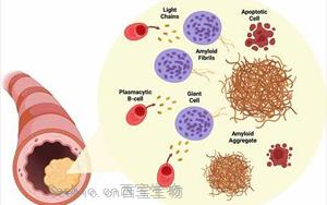 NEJM综述：淀粉样变性的发病机制、研究和治疗