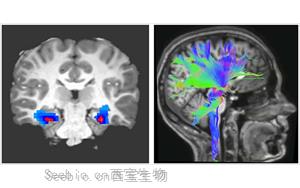 Nature Medicine：一种新的<font color='red'>强迫症</font>神经生物标志物